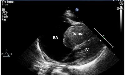 Case report: Cardiac intimal sarcoma in a young child